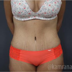 Tummy Tuck Before & After Patient #2858