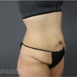 Tummy Tuck Before & After Patient #2858