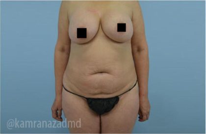 Tummy Tuck Before & After Patient #2859