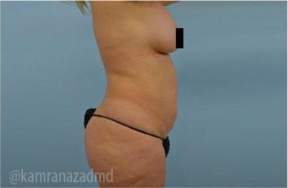 Tummy Tuck Before & After Patient #2859