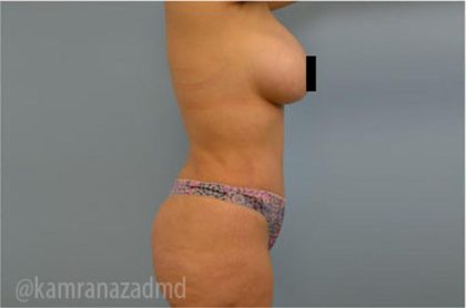 Tummy Tuck Before & After Patient #2859