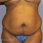 Tummy Tuck Before & After Patient #2860