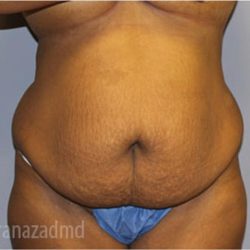 Tummy Tuck Before & After Patient #2860