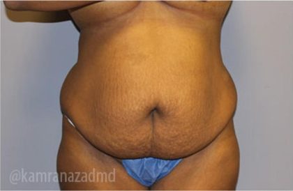 Tummy Tuck Before & After Patient #2860