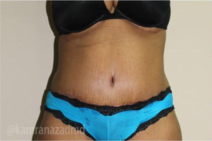 Tummy Tuck Before & After Patient #2860