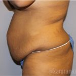 Tummy Tuck Before & After Patient #2860