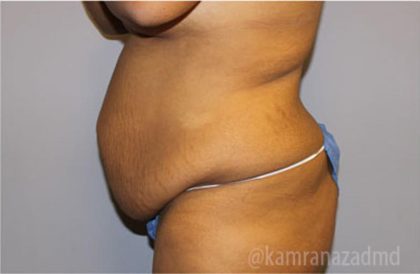 Tummy Tuck Before & After Patient #2860