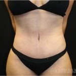 Tummy Tuck Before & After Patient #2861