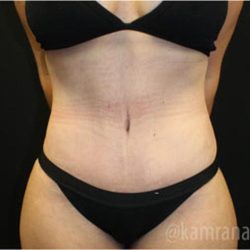 Tummy Tuck Before & After Patient #2861