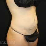 Tummy Tuck Before & After Patient #2861