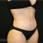 Tummy Tuck Before & After Patient #2861