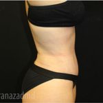 Tummy Tuck Before & After Patient #2861