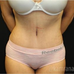 Tummy Tuck Before & After Patient #2862