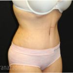 Tummy Tuck Before & After Patient #2862