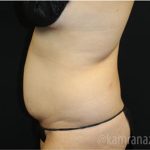 Tummy Tuck Before & After Patient #2862