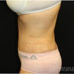 Tummy Tuck Before & After Patient #2862