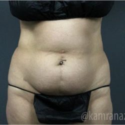 Tummy Tuck Before & After Patient #2826