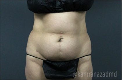 Tummy Tuck Before & After Patient #2826