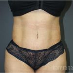Tummy Tuck Before & After Patient #2826