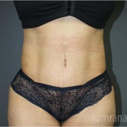 Tummy Tuck Before & After Patient #2826