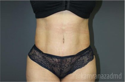 Tummy Tuck Before & After Patient #2826
