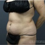 Tummy Tuck Before & After Patient #2826