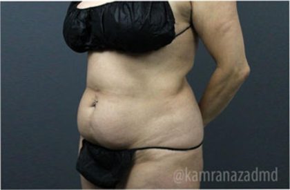 Tummy Tuck Before & After Patient #2826