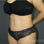 Tummy Tuck Before & After Patient #2826