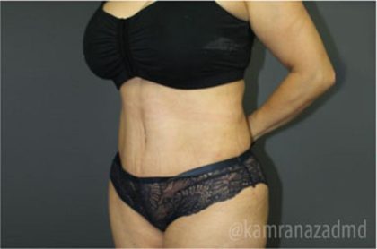 Tummy Tuck Before & After Patient #2826