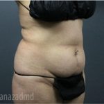 Tummy Tuck Before & After Patient #2826