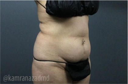 Tummy Tuck Before & After Patient #2826