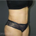 Tummy Tuck Before & After Patient #2826