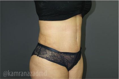Tummy Tuck Before & After Patient #2826