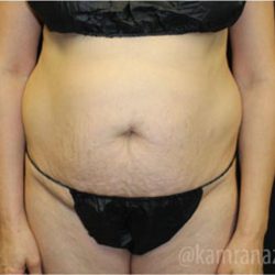 Tummy Tuck Before & After Patient #2863