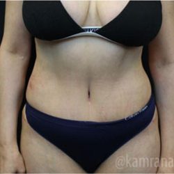 Tummy Tuck Before & After Patient #2863