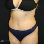 Tummy Tuck Before & After Patient #2863