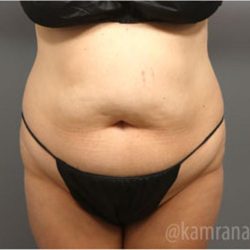 Tummy Tuck Before & After Patient #2864