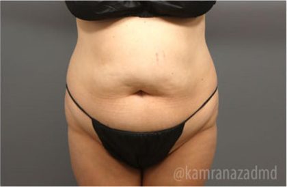 Tummy Tuck Before & After Patient #2864