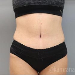 Tummy Tuck Before & After Patient #2864