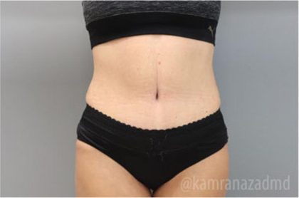 Tummy Tuck Before & After Patient #2864