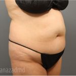 Tummy Tuck Before & After Patient #2864