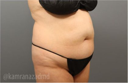 Tummy Tuck Before & After Patient #2864