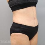 Tummy Tuck Before & After Patient #2864