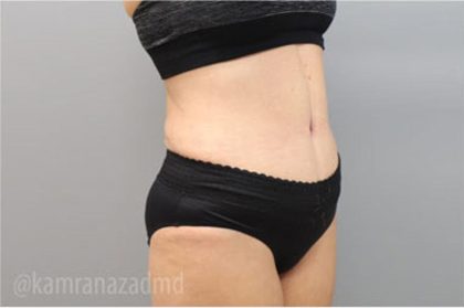Tummy Tuck Before & After Patient #2864
