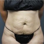 Tummy Tuck Before & After Patient #2865