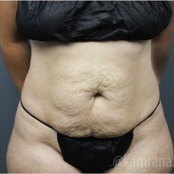 Tummy Tuck Before & After Patient #2865