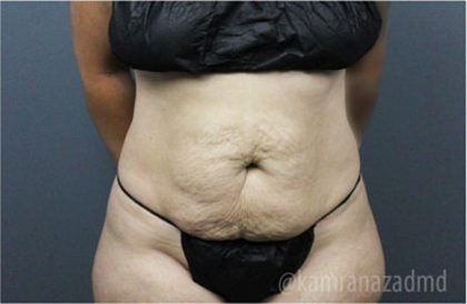 Tummy Tuck Before & After Patient #2865