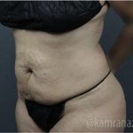 Tummy Tuck Before & After Patient #2865