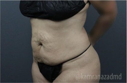 Tummy Tuck Before & After Patient #2865
