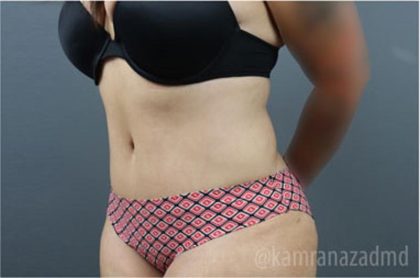 Tummy Tuck Before & After Patient #2865